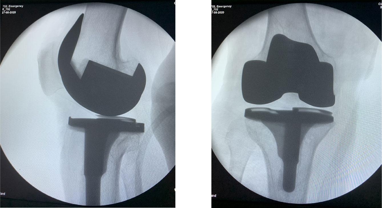 Nika amandla i-Femoral-Component-11
