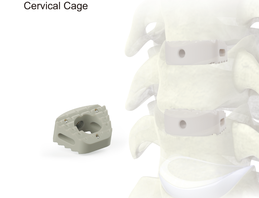 Cervical Cage Implant