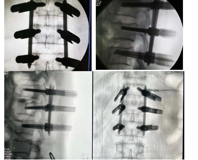 Polyaxial Pedicle Screw